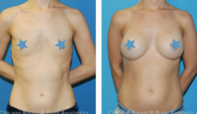 breast augmentation surgery before after chicago
