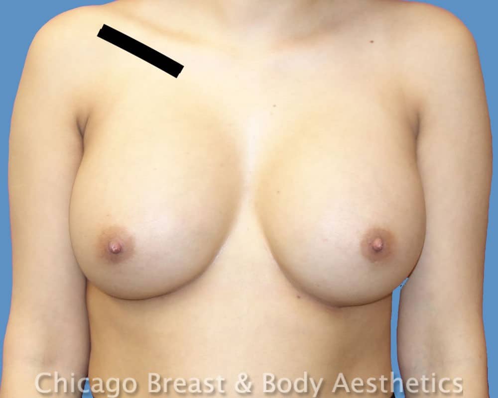Chicago Breast and Body