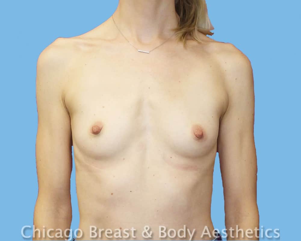 Chicago Breast and Body