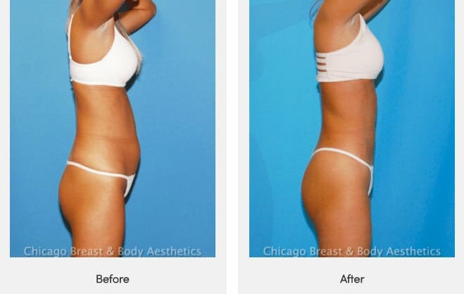 hi definition liposuction before after