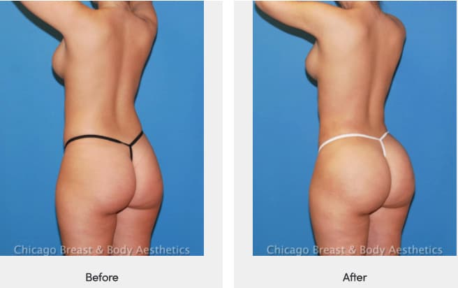 best bbl brazilian butt lift surgeon before after
