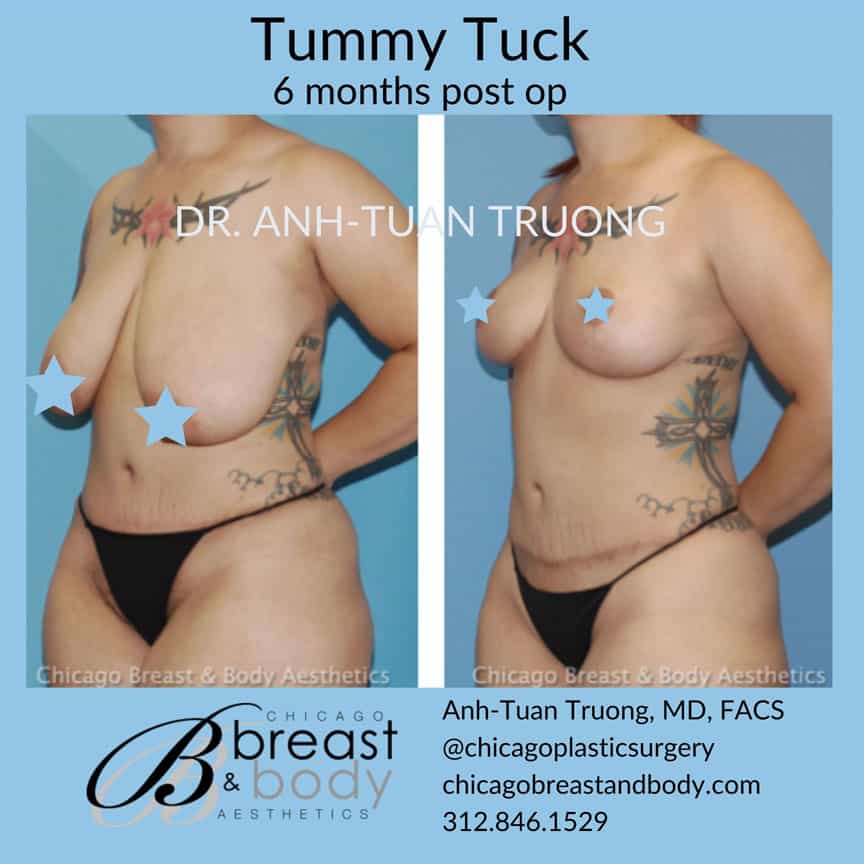 Mommy makeover tummy tuck breast lift by Dr. Truong