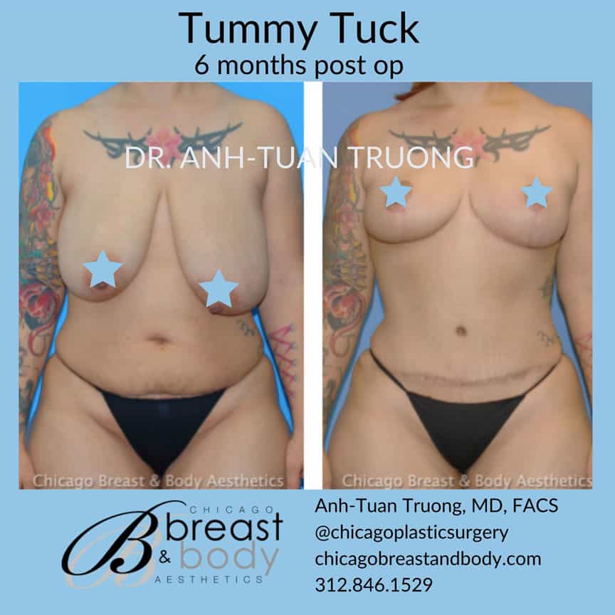 Mommy makeover tummy tuck before after Chicago