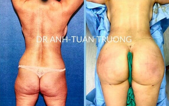 Patient underwent Lipo 360 and Brazilian Butt Lift by Dr. Anh-Tuan Truong with 900cc each side.