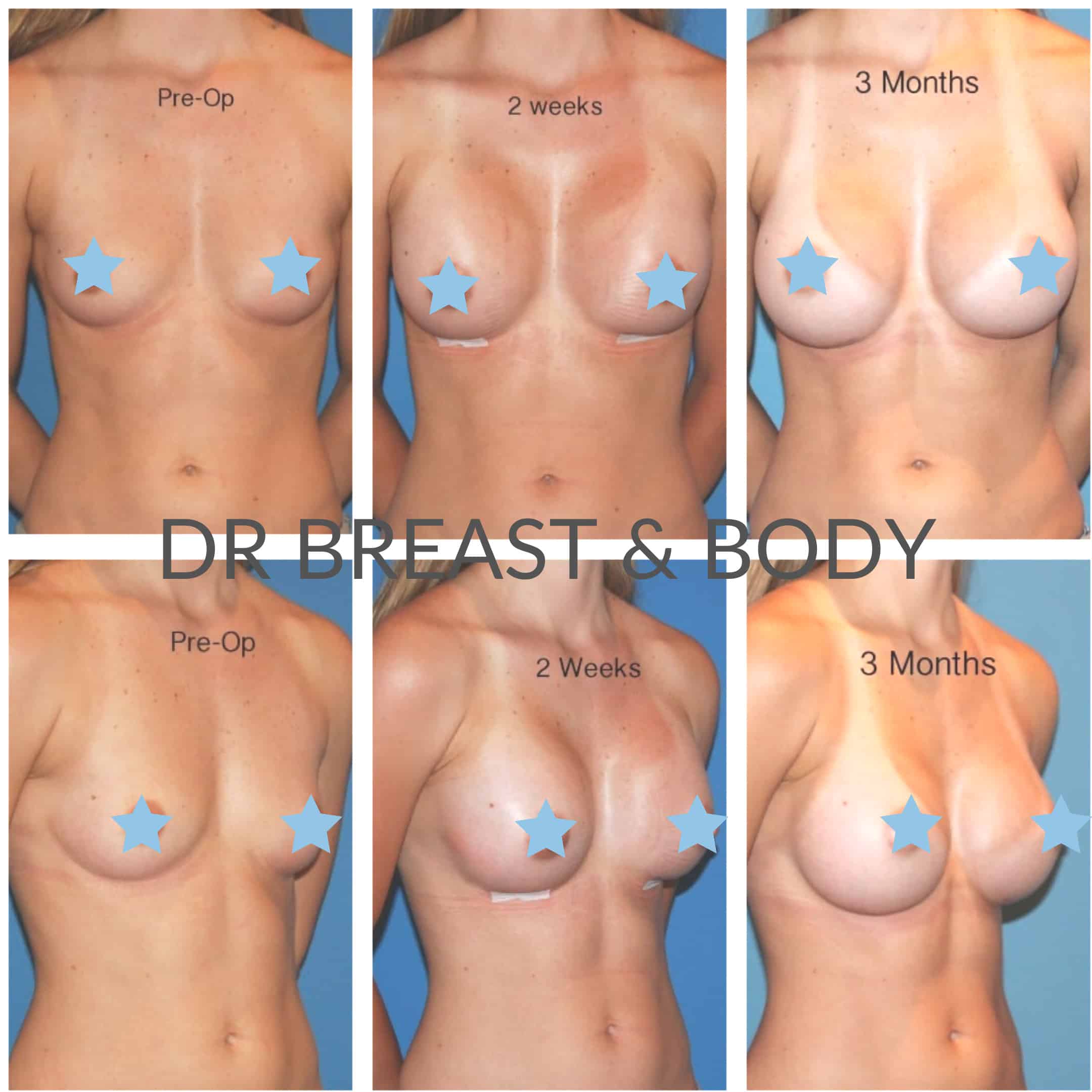 breast augmentation healing recovery