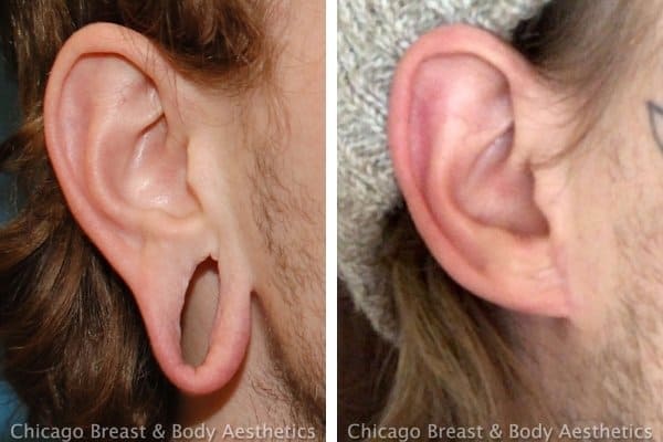 earlobe repair surgery before after photo