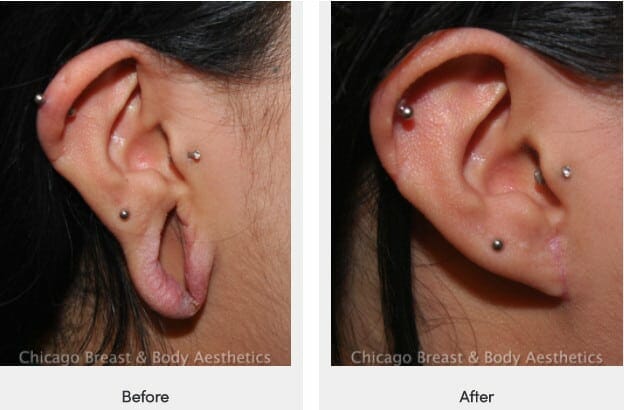 earlobe repair surgery before after chicago