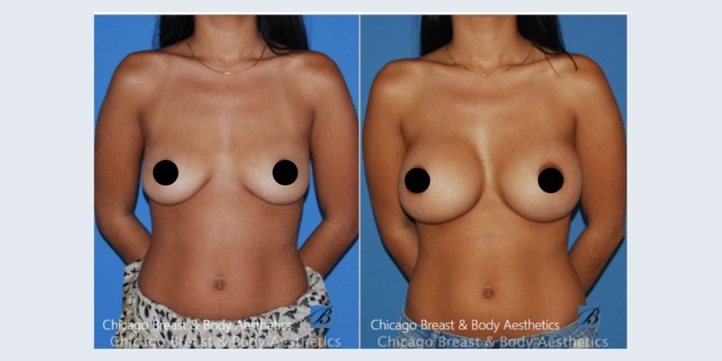 breast augmentation silicone before after chicago