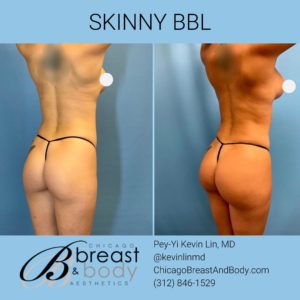skinny brazilian butt lift chicago