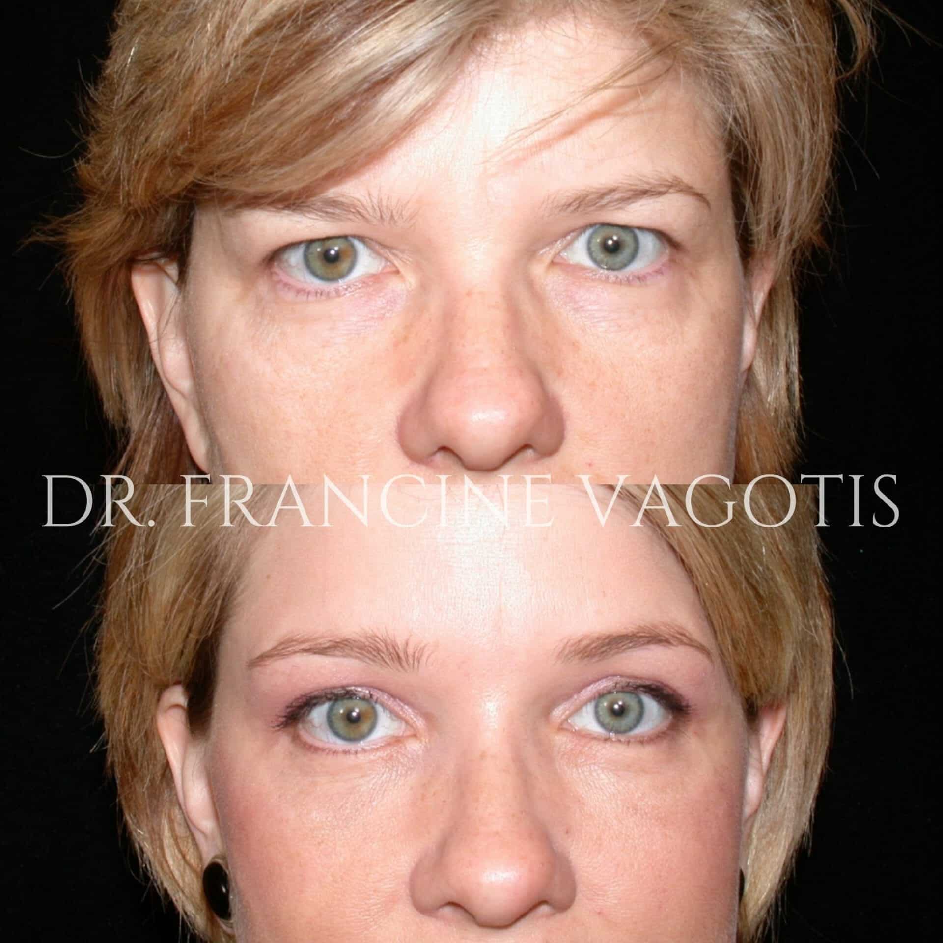 blepharoplasty eyelid brow lift before after