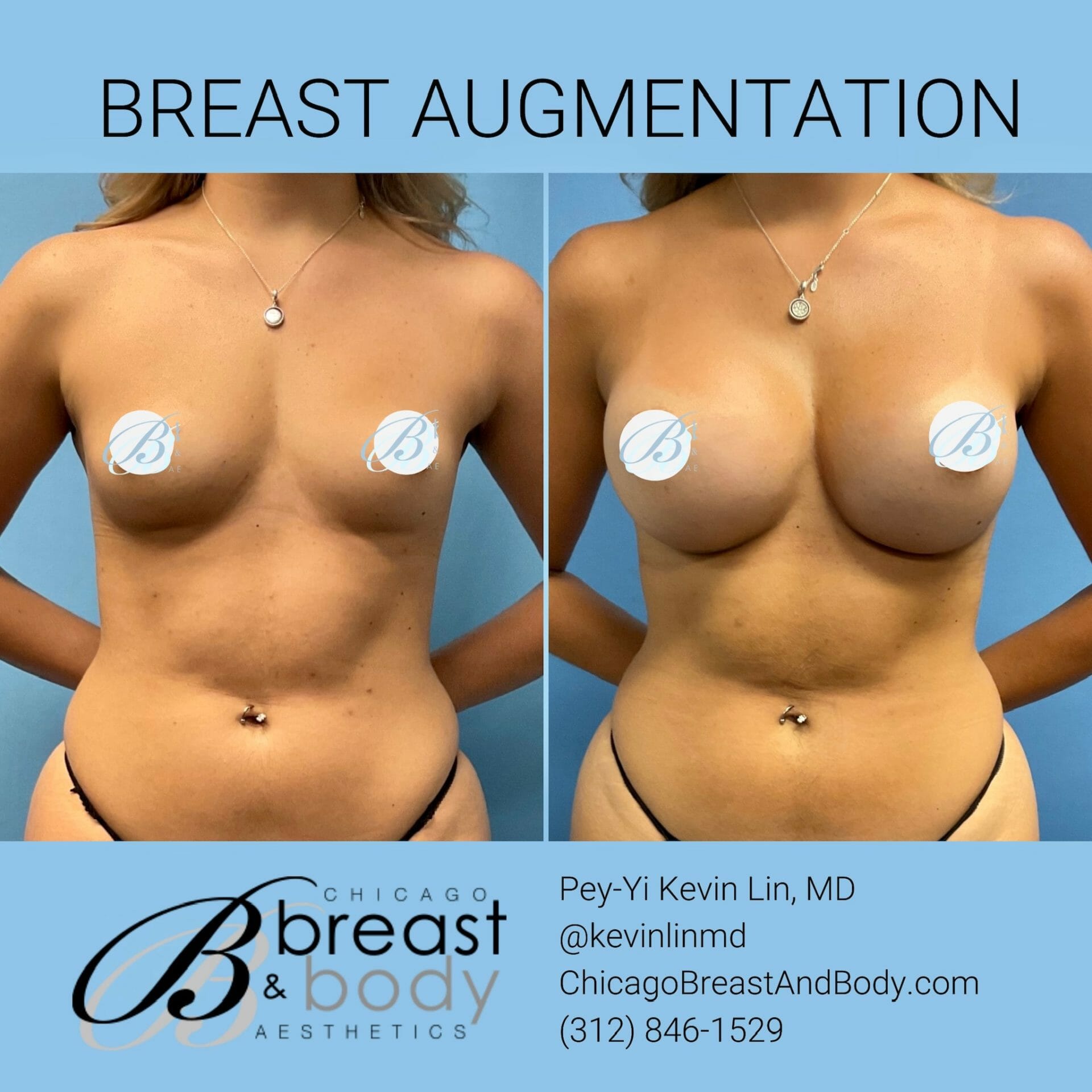 Breast Implant Surgeon Chicago