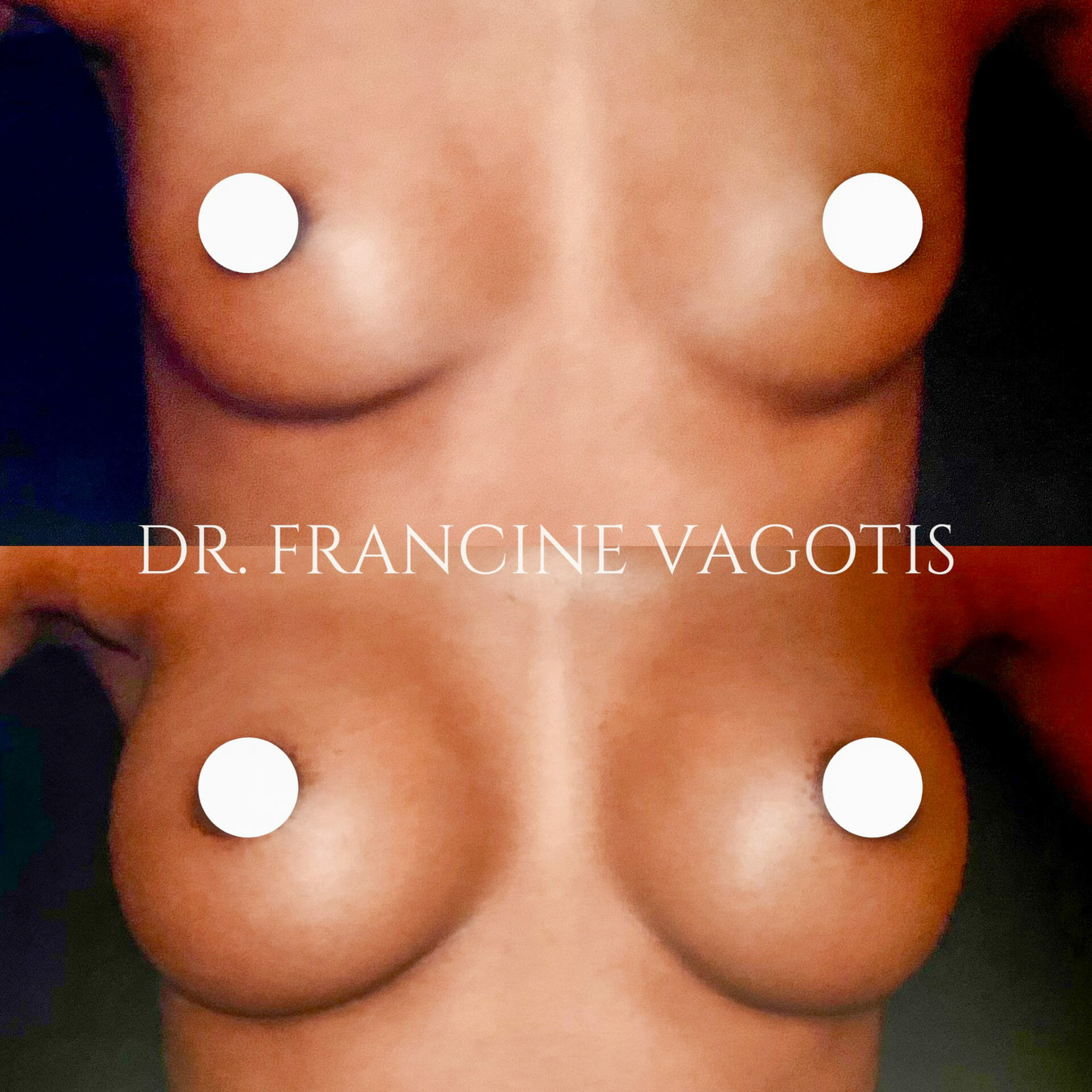 Breast implants before after vagotis