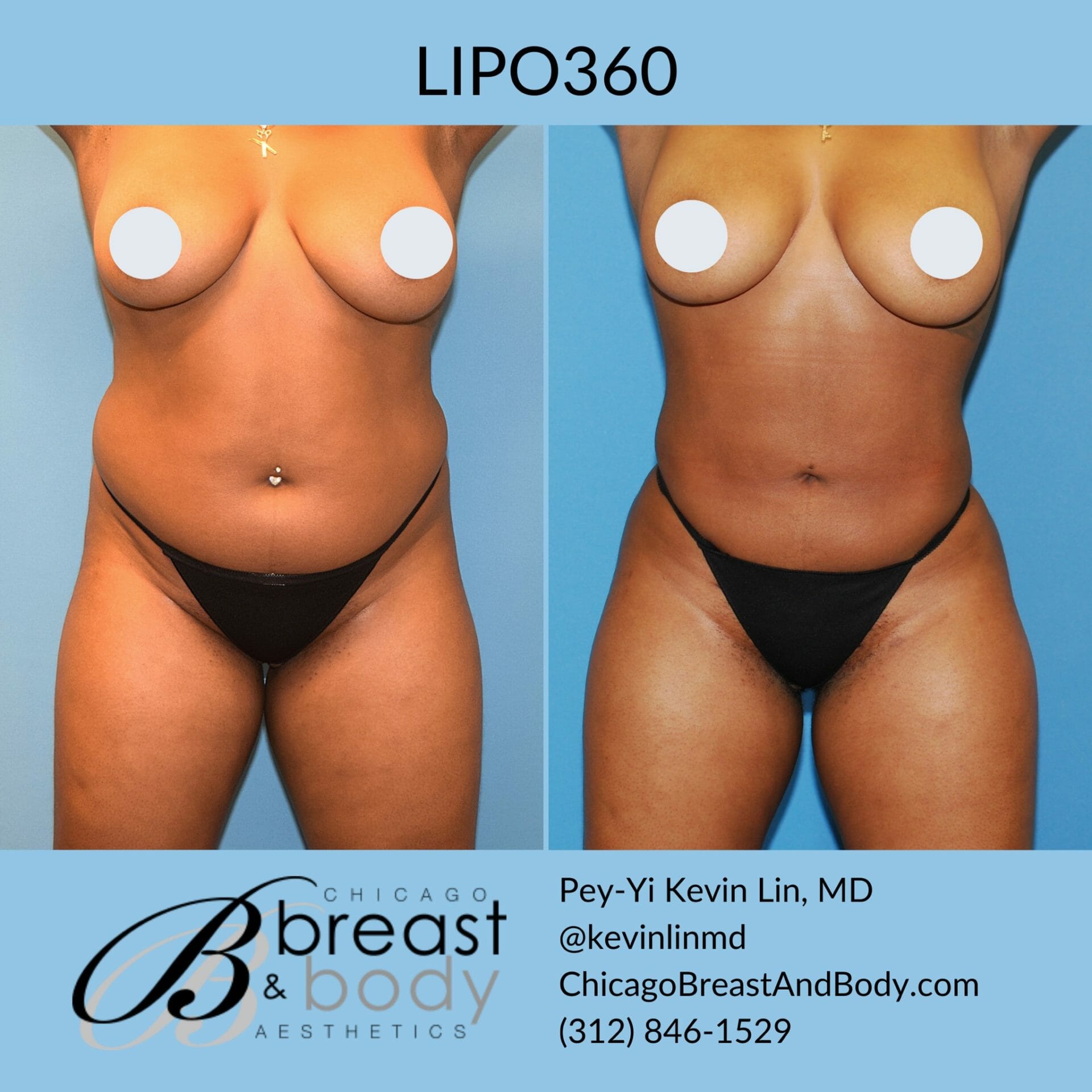 lipo 360 before after photo chicago