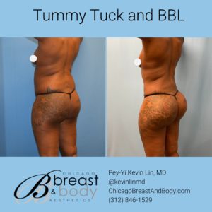 can you get bbl and tummy tuck at the same time