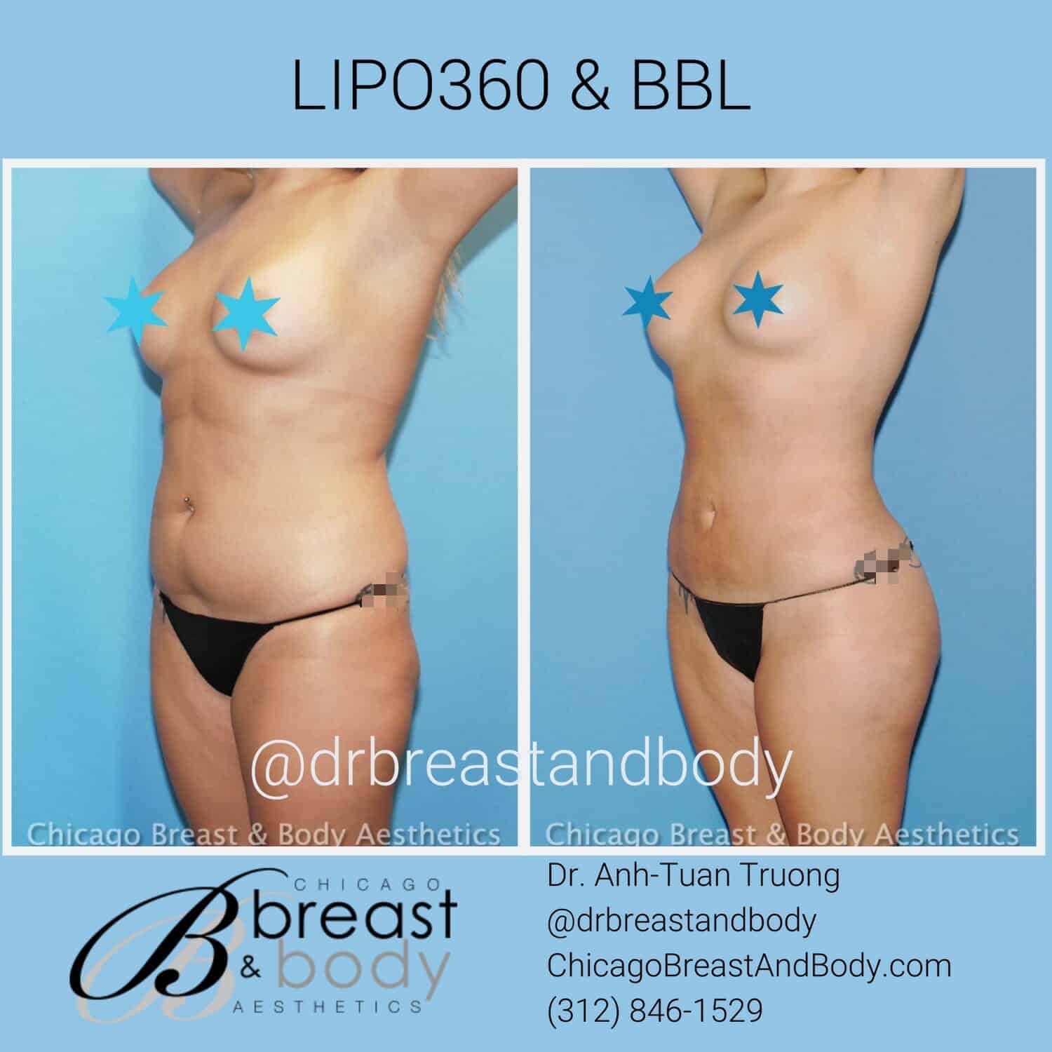 what is lipo 360