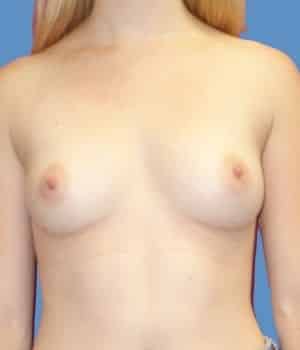 Breast Augmentation Case# 1239