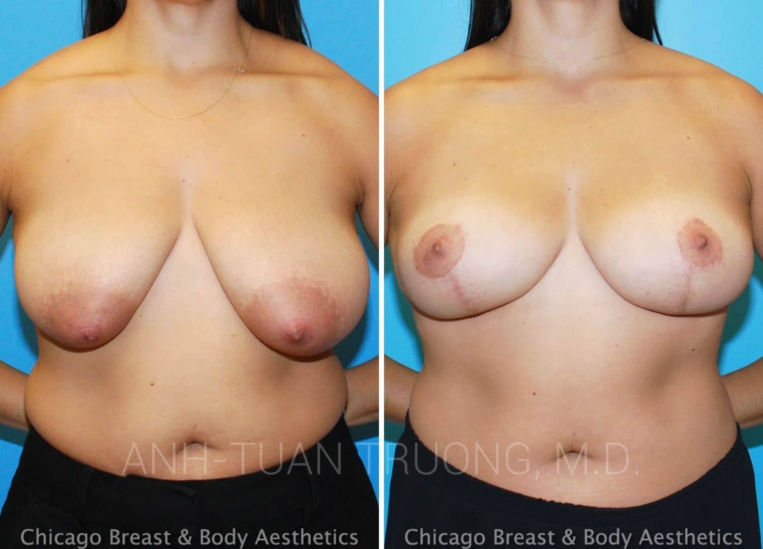 breast reduction surgeon chicago