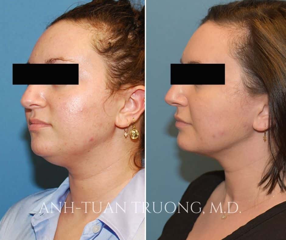 jplasma neck liposuction before after chicago