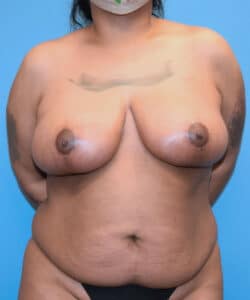 breast lift before after scarring chicago breast and body 6