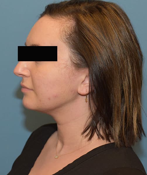 chin neck liposuction before after chicago 4