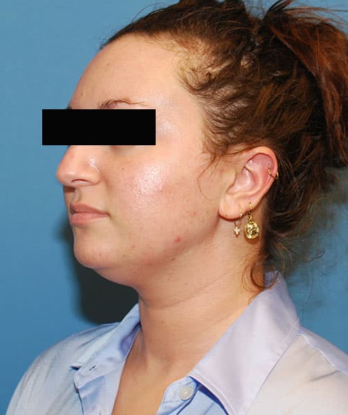 chin neck liposuction before after chicago 5