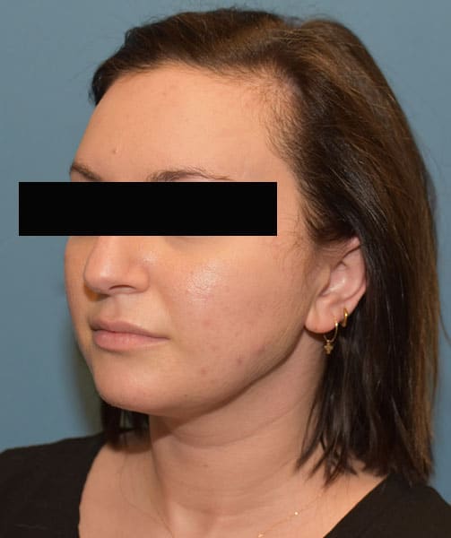 chin neck liposuction before after chicago 6