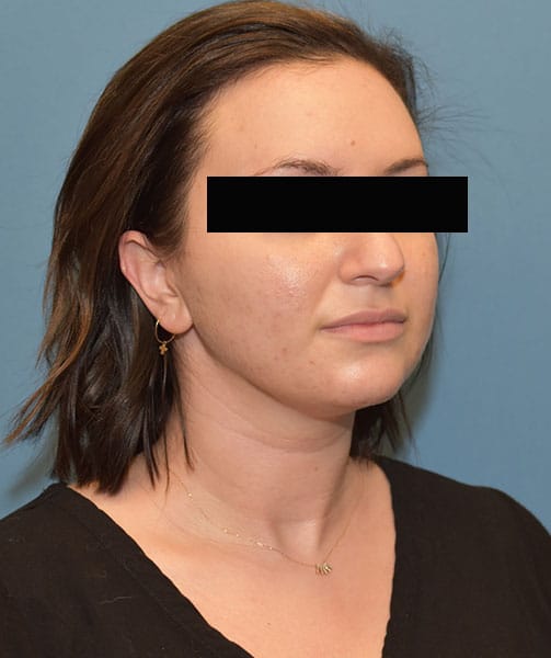 chin neck liposuction before after chicago 7