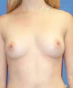Breast Augmentation Before After Photo # 1239 by Dr. Kevin Lin Chicago Breast & Body Aesthetics
