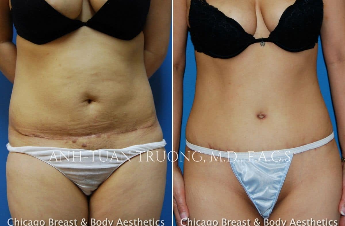 mini tummy tuck before after photo