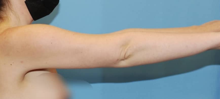 arm liposuction before after chicago1