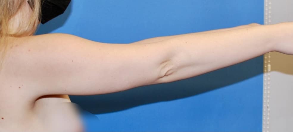 arm liposuction before after chicago4