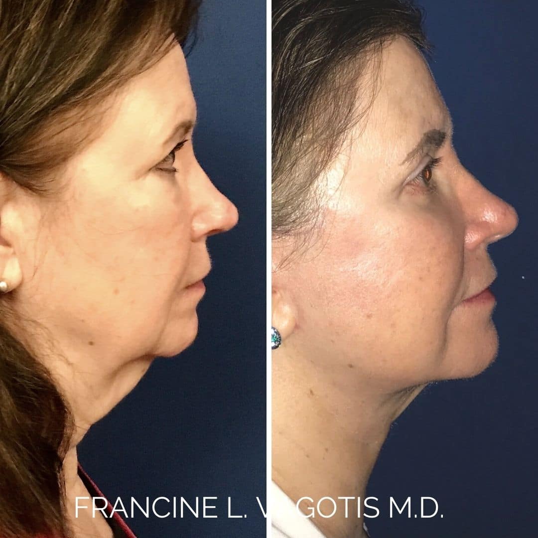 facelift chicago before after