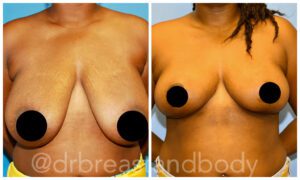 breast reduction surgery chicago