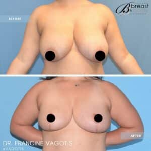 breast reduction and lift surgeon
