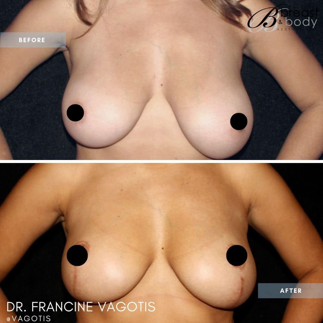 before after breast reduction