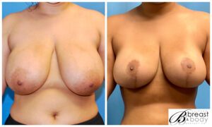 breast reduction surgeon chicago