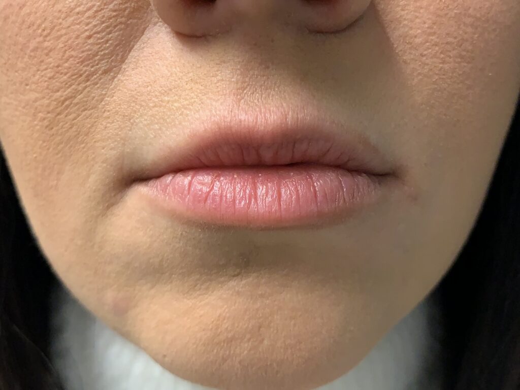 lip fillers before after