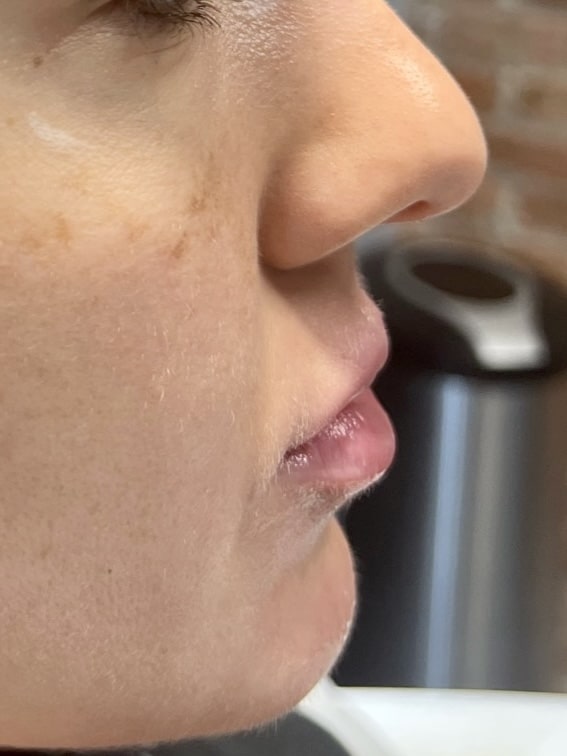 versa lips before and after1