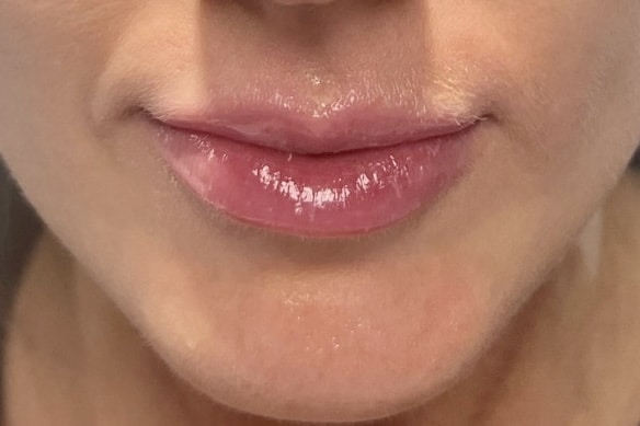 versa lip injections near me