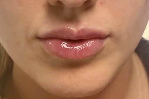versa lips before and after3