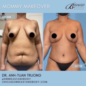 mommy makeover before after chicago