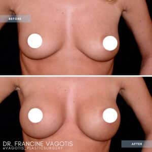 breast augmentation vagotis