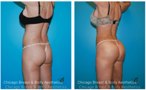 Athletic BBL Before After