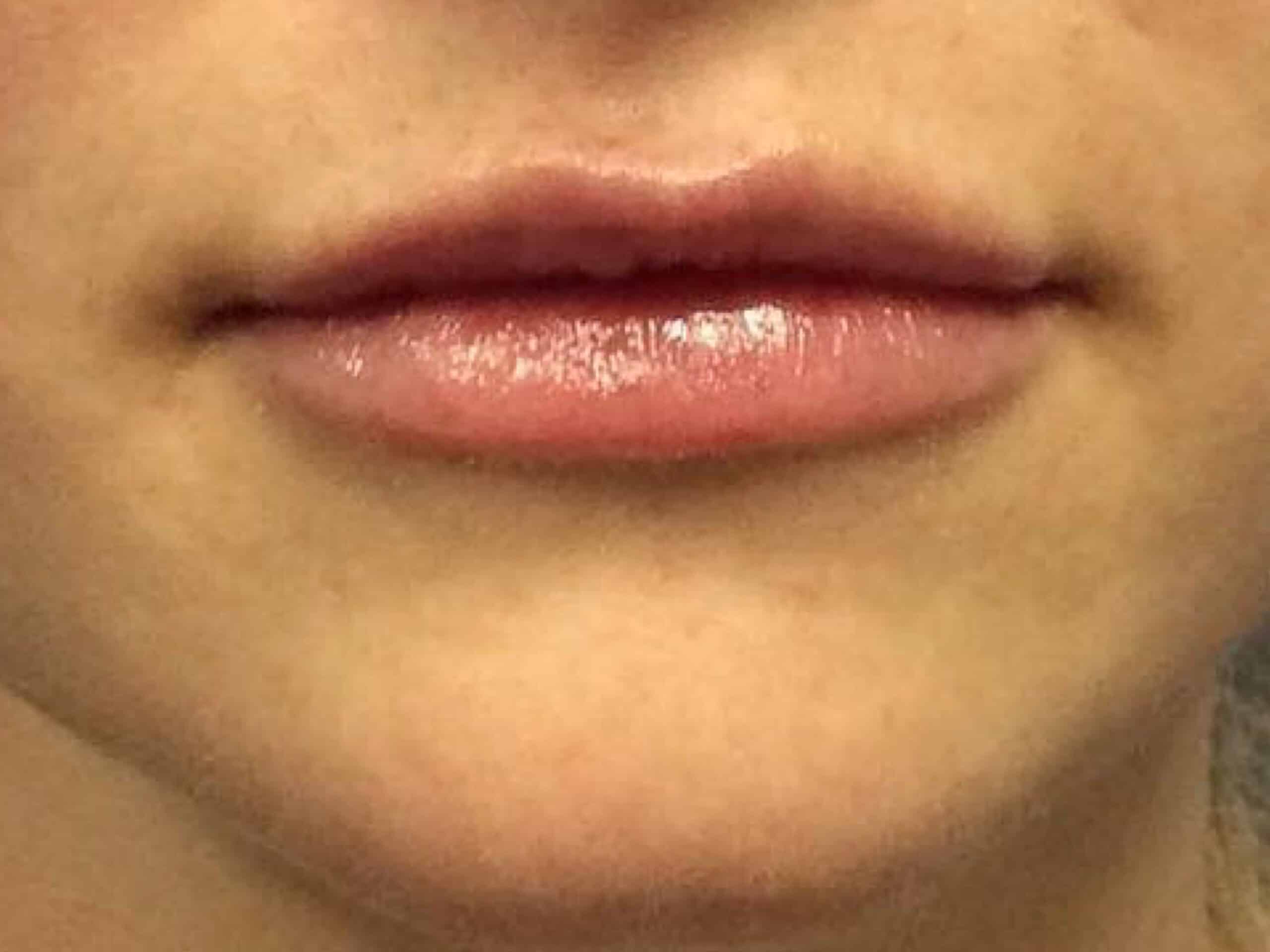 juvederm lip injections before after2