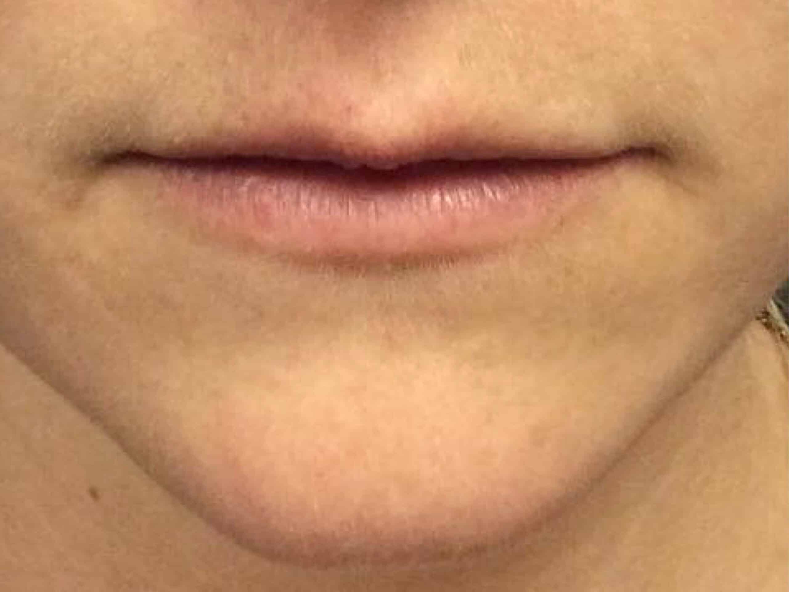 juvederm lip injections before after