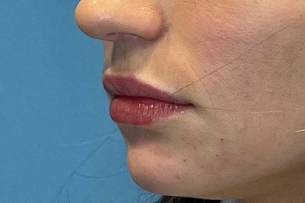  Lip Fillers Injection 112