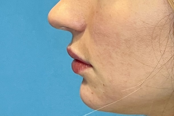  Lip Fillers Injection 112