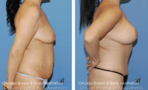 breast lift before after photos chicago