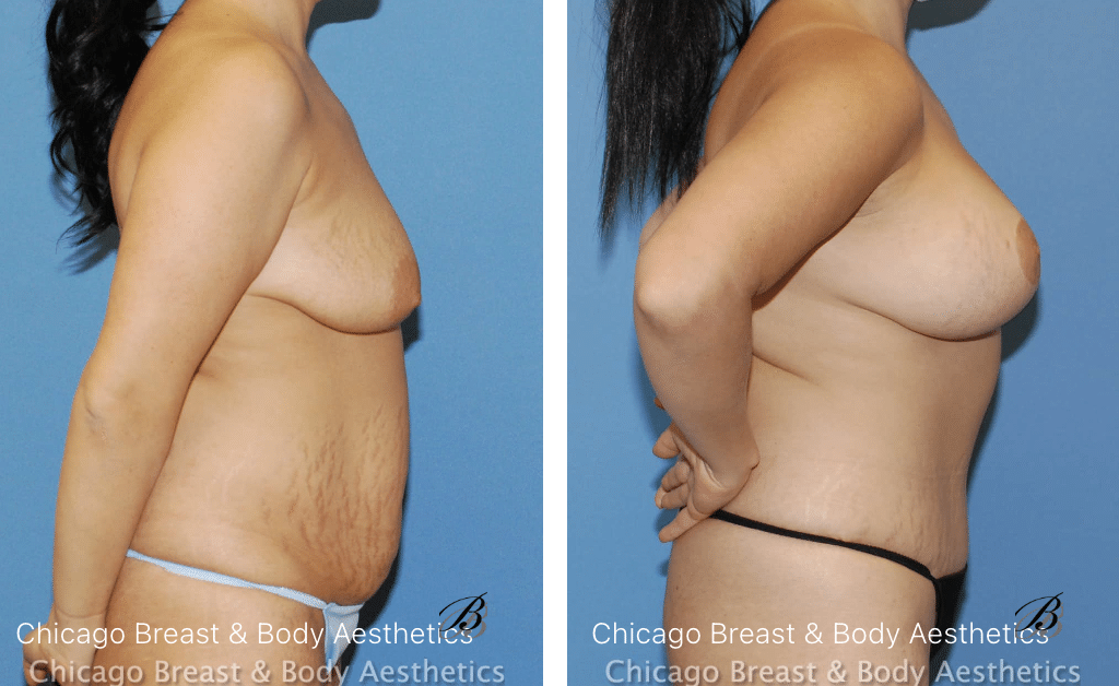 breast lift before after photos chicago