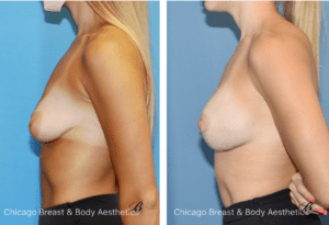 breast lift mastopexy photos